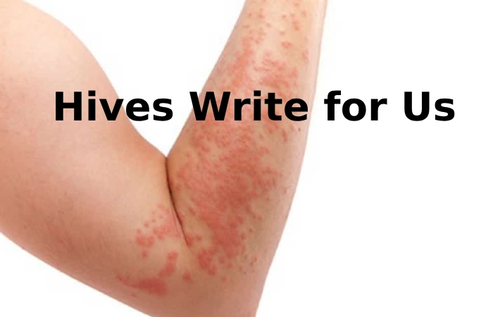 Hives Write for Us