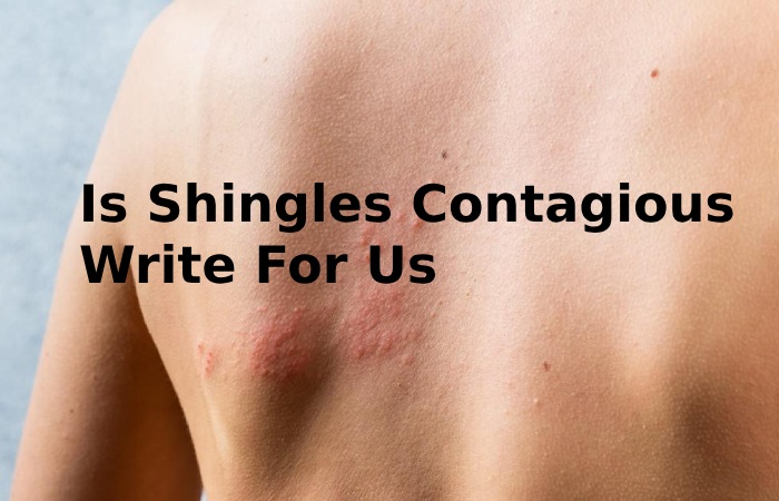 Is Shingles Contagious Write For Us