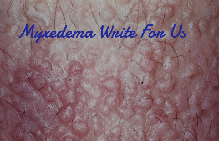 Myxedema Write For Us 
