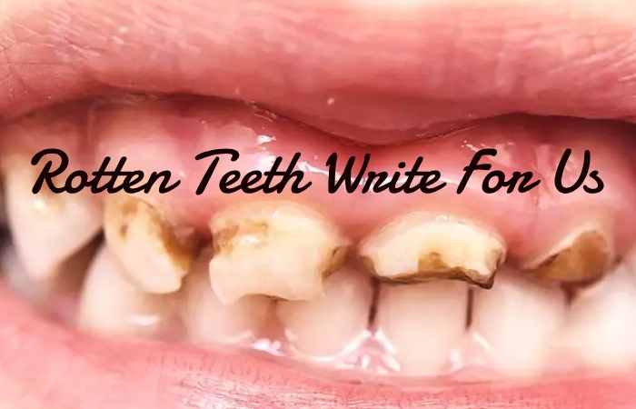 Rotten Teeth Write For Us