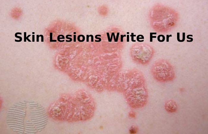 Skin Lesions Write For Us 