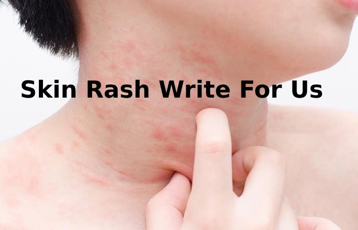 Skin Rash Write For Us